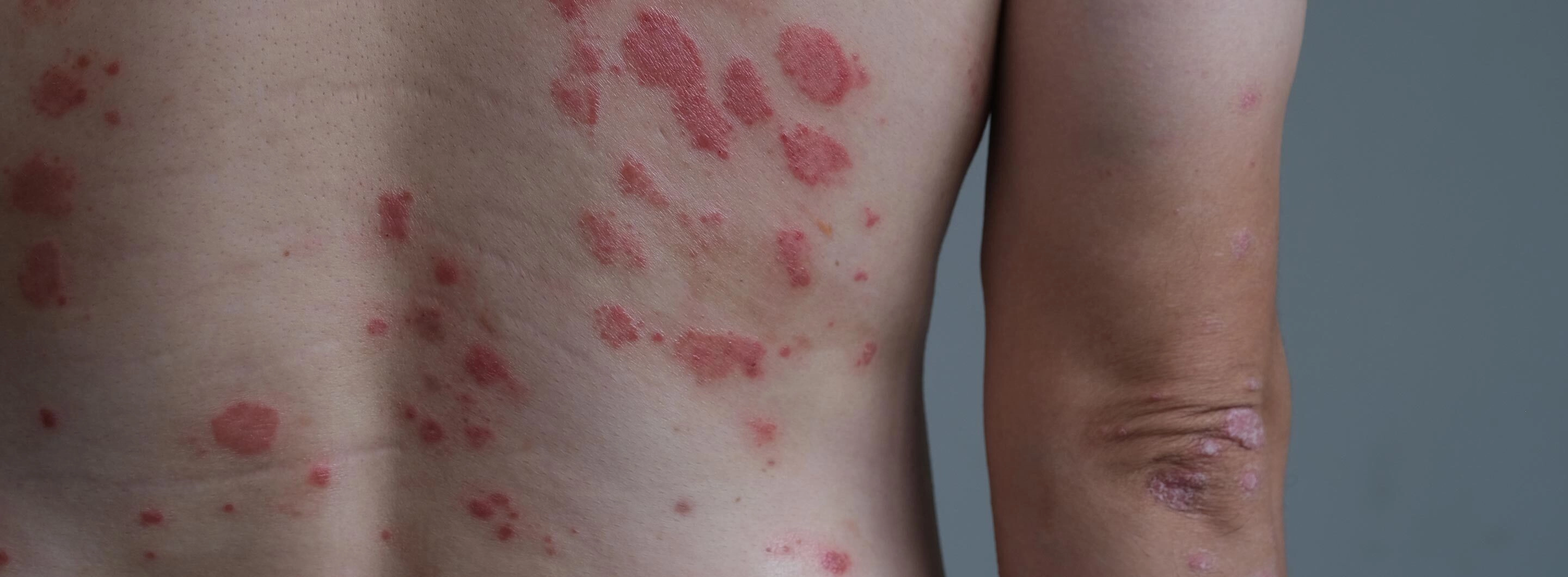 General Dermatology