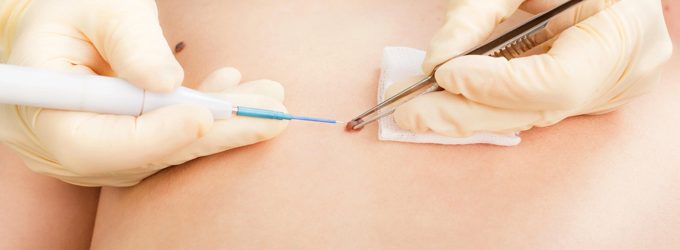 Skin Cancer